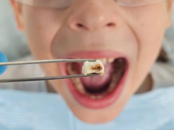 Best Emergency Wisdom Teeth Removal in Whitewater, KS